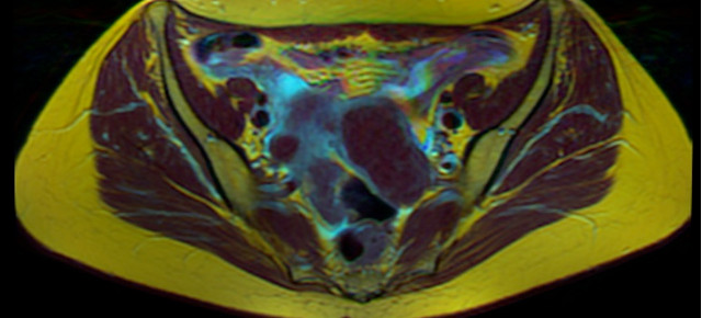 scan of a fibroid