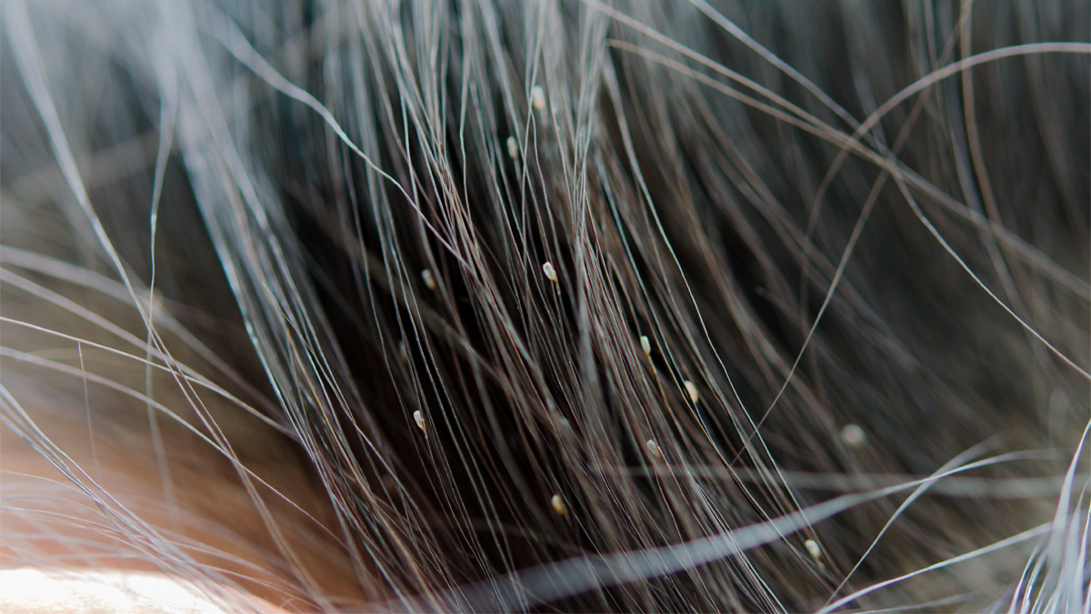 Close-up of headlice in a person's hair