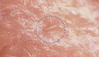 A Demodex folliculorum skin mite on skin