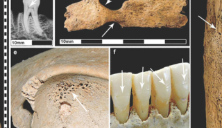 [Indicators of stress on some of the Roman Period adult female skeletons: (credit:  Rebecca Pitt)]