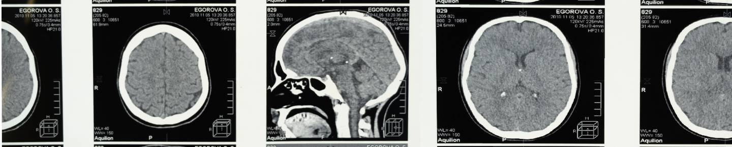 A row of five black and white brain scans.